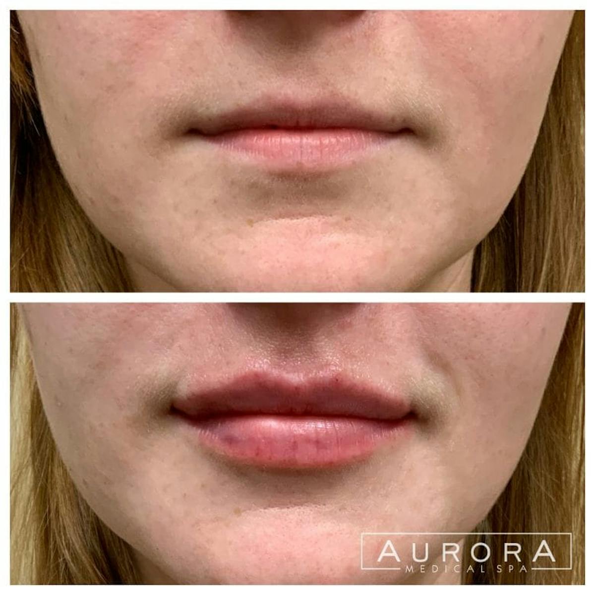 Lip Filler Before & After Gallery - Patient 689794 - Image 1