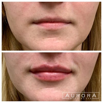 Lip Filler Before & After Gallery - Patient 689794 - Image 1