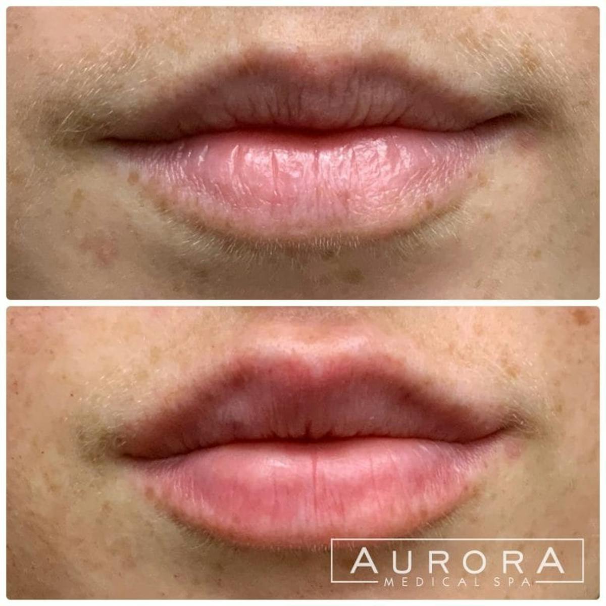 Lip Filler Before & After Gallery - Patient 715811 - Image 1