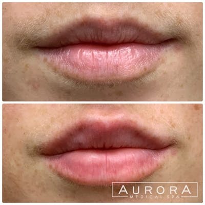 Lip Filler Before & After Gallery - Patient 715811 - Image 1