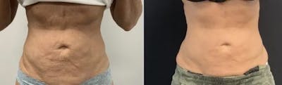 Emsculpt Neo Before & After Gallery - Patient 350191 - Image 1