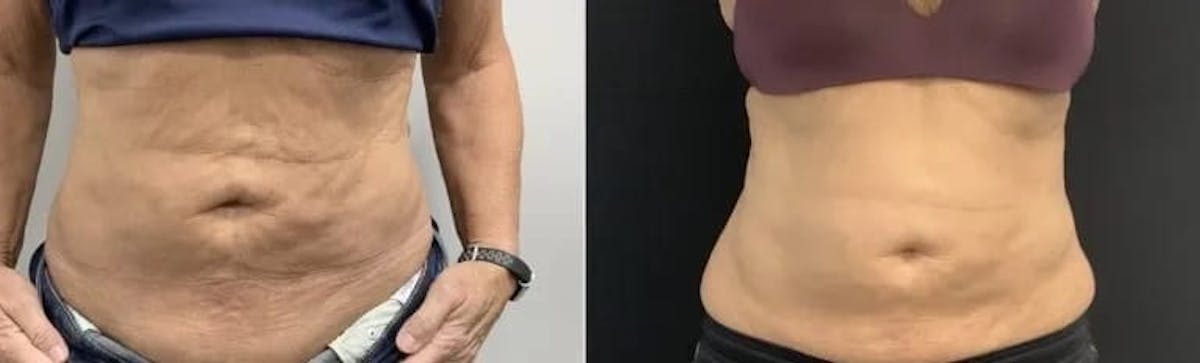 Emsculpt Neo Before & After Gallery - Patient 212101 - Image 1