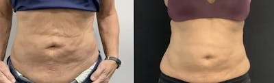 Emsculpt Neo Before & After Gallery - Patient 212101 - Image 1