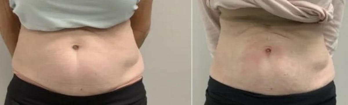 Emsculpt Neo Before & After Gallery - Patient 266086 - Image 1