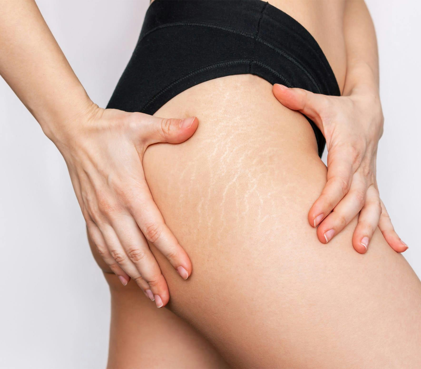 Stretch Marks Cream