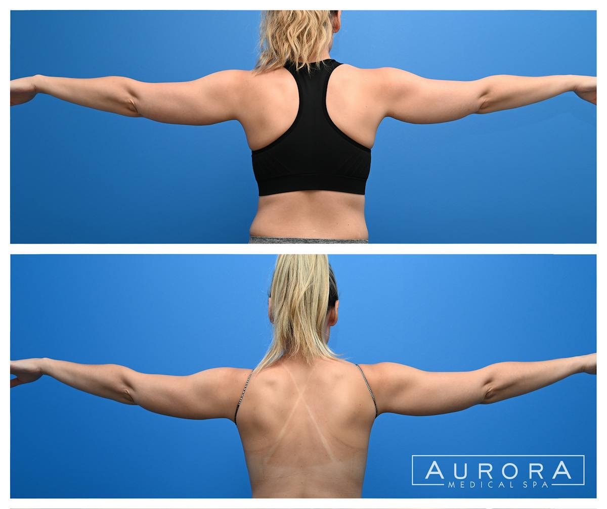 Coolsculpting Elite Before & After Gallery - Patient 959725 - Image 1
