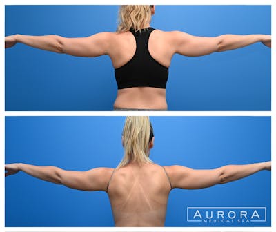 Coolsculpting Elite Before & After Gallery - Patient 959725 - Image 1