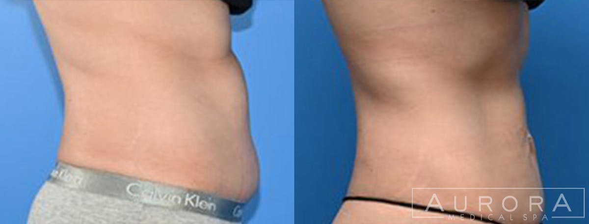 Coolsculpting Elite Before & After Gallery - Patient 444292 - Image 2
