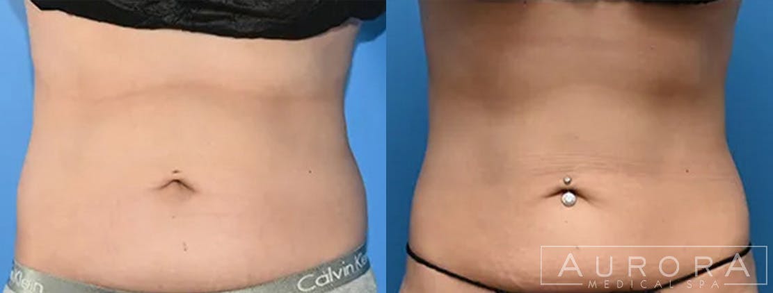 Coolsculpting Elite