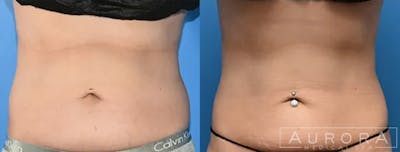 Coolsculpting Elite Before & After Gallery - Patient 444292 - Image 1