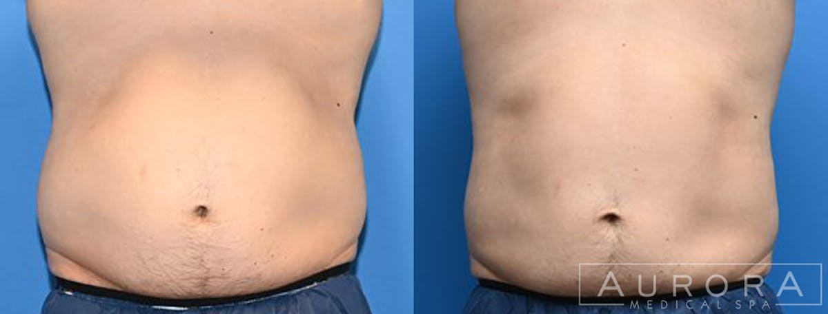 Coolsculpting Elite Before & After Gallery - Patient 334186 - Image 1