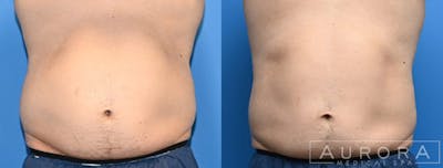 Coolsculpting Elite Before & After Gallery - Patient 334186 - Image 1
