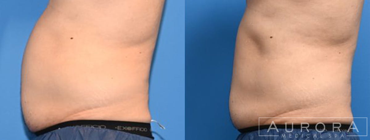 Coolsculpting Elite Before & After Gallery - Patient 334186 - Image 2