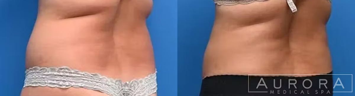 Coolsculpting Elite Before & After Gallery - Patient 200305 - Image 3