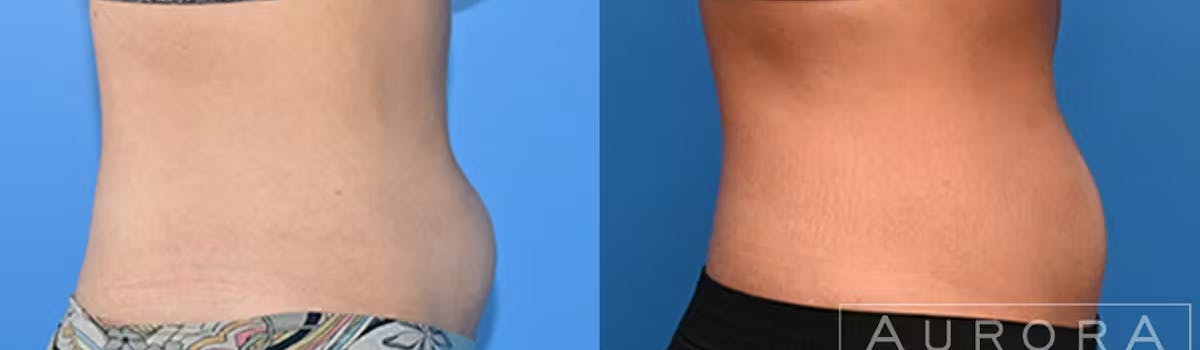 Coolsculpting Elite Before & After Gallery - Patient 324428 - Image 1