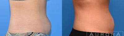 Coolsculpting Elite Before & After Gallery - Patient 324428 - Image 1