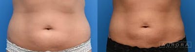 Coolsculpting Elite Before & After Gallery - Patient 200305 - Image 1