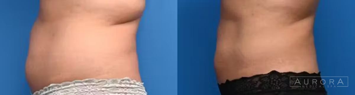Coolsculpting Elite Before & After Gallery - Patient 200305 - Image 2
