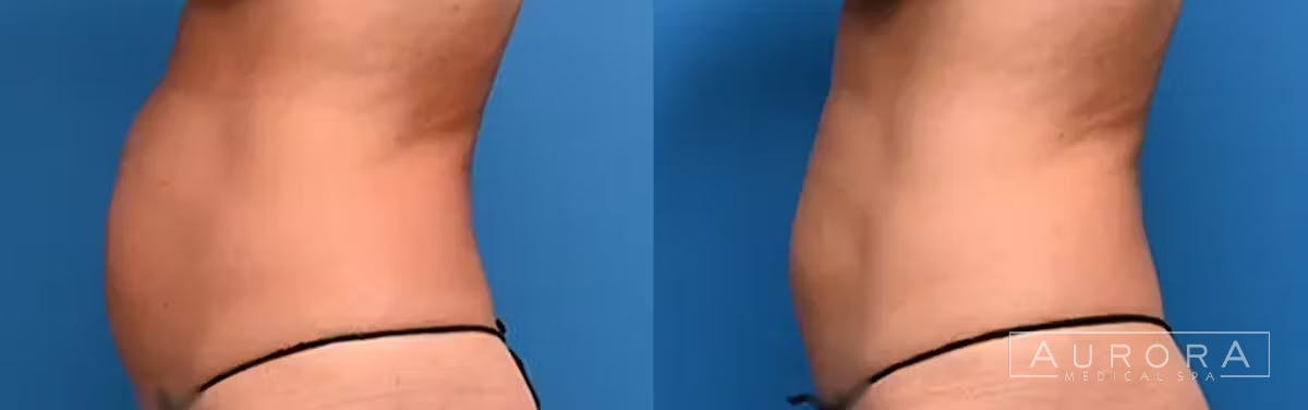 Coolsculpting Elite Before & After Gallery - Patient 179599 - Image 1