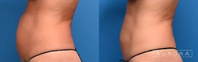 Coolsculpting Elite Before & After Gallery - Patient 179599 - Image 1