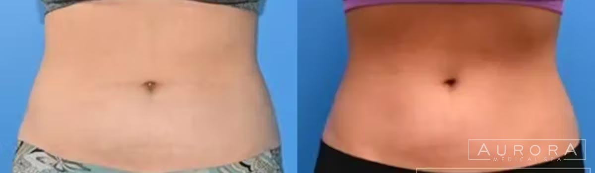 Coolsculpting Elite Before & After Gallery - Patient 324428 - Image 2