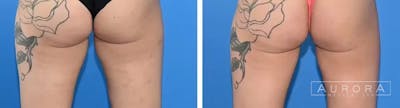 Coolsculpting Elite Before & After Gallery - Patient 166971 - Image 1