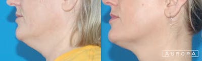 Coolsculpting Elite Before & After Gallery - Patient 439215 - Image 1