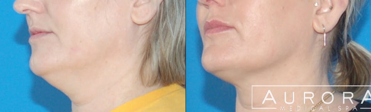 Coolsculpting Elite Before & After Gallery - Patient 439215 - Image 2