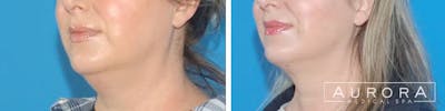 Coolsculpting Elite Before & After Gallery - Patient 229387 - Image 1