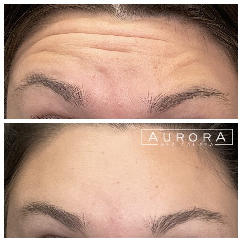 wrinkle relaxer procedure