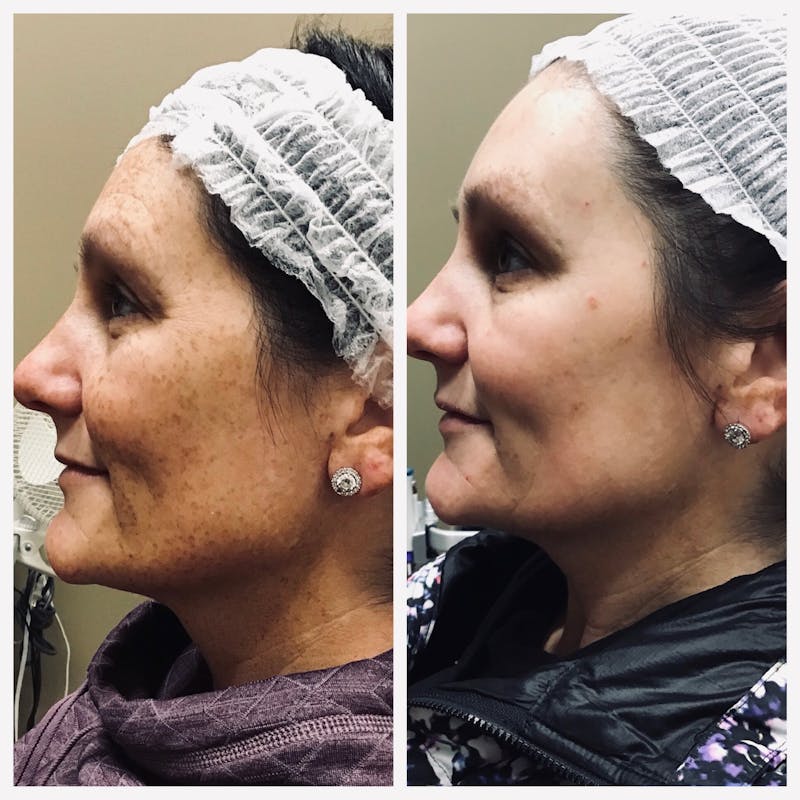 IPL Before & After Gallery - Patient 392050 - Image 2