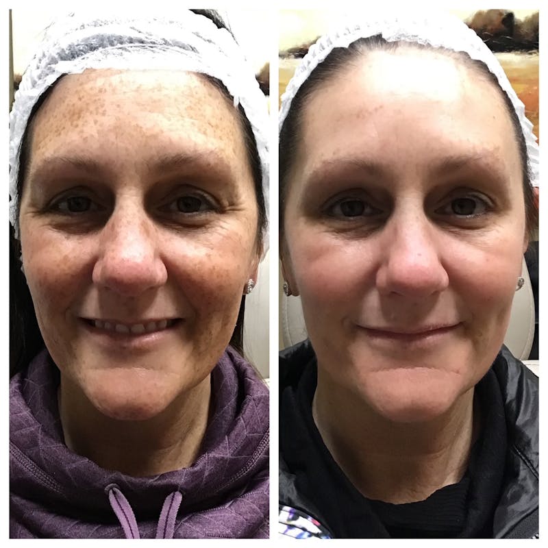 IPL Before & After Gallery - Patient 392050 - Image 1