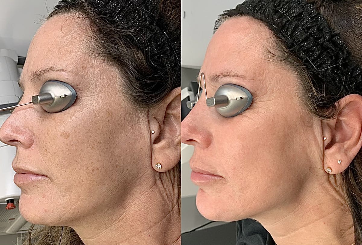 IPL Before & After Gallery - Patient 332440 - Image 1