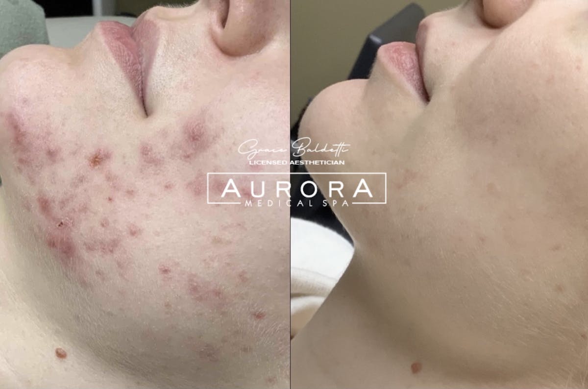 LaseMD Before & After Gallery - Patient 283886 - Image 1