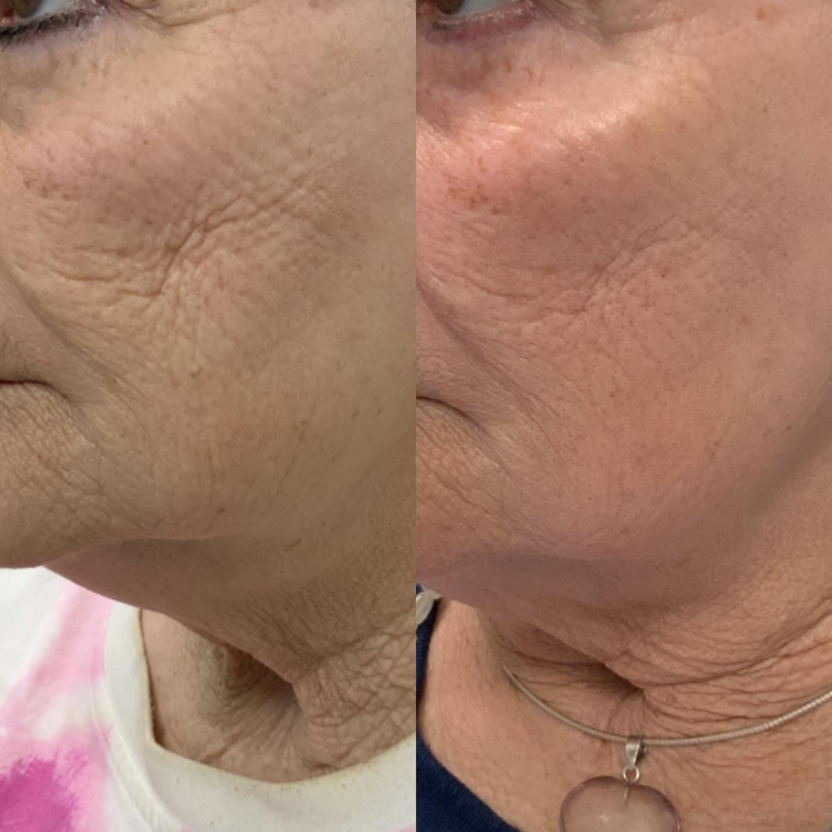 Sculptra Before & After Gallery - Patient 307008 - Image 1