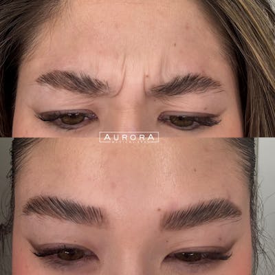 BOTOX Before & After Gallery - Patient 102825 - Image 1
