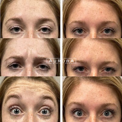 BOTOX Before & After Gallery - Patient 111290 - Image 1