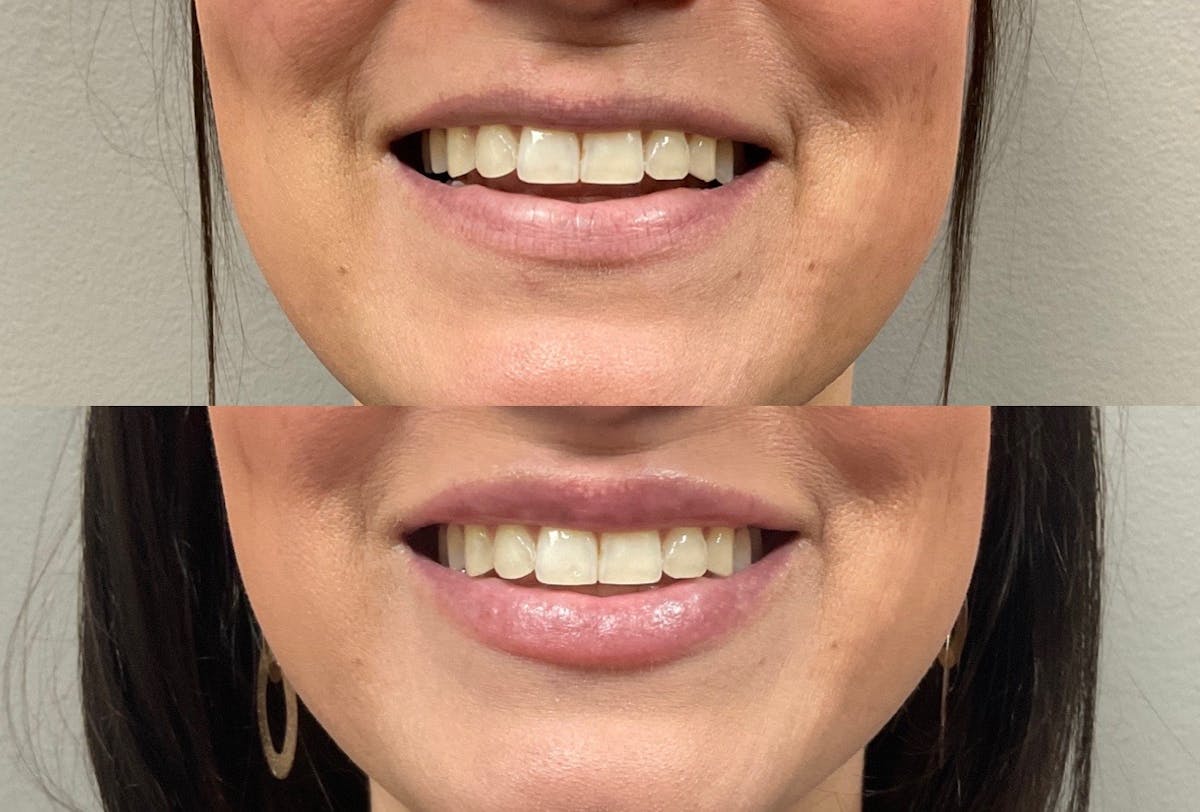 Lip Filler Before & After Gallery - Patient 630189 - Image 1