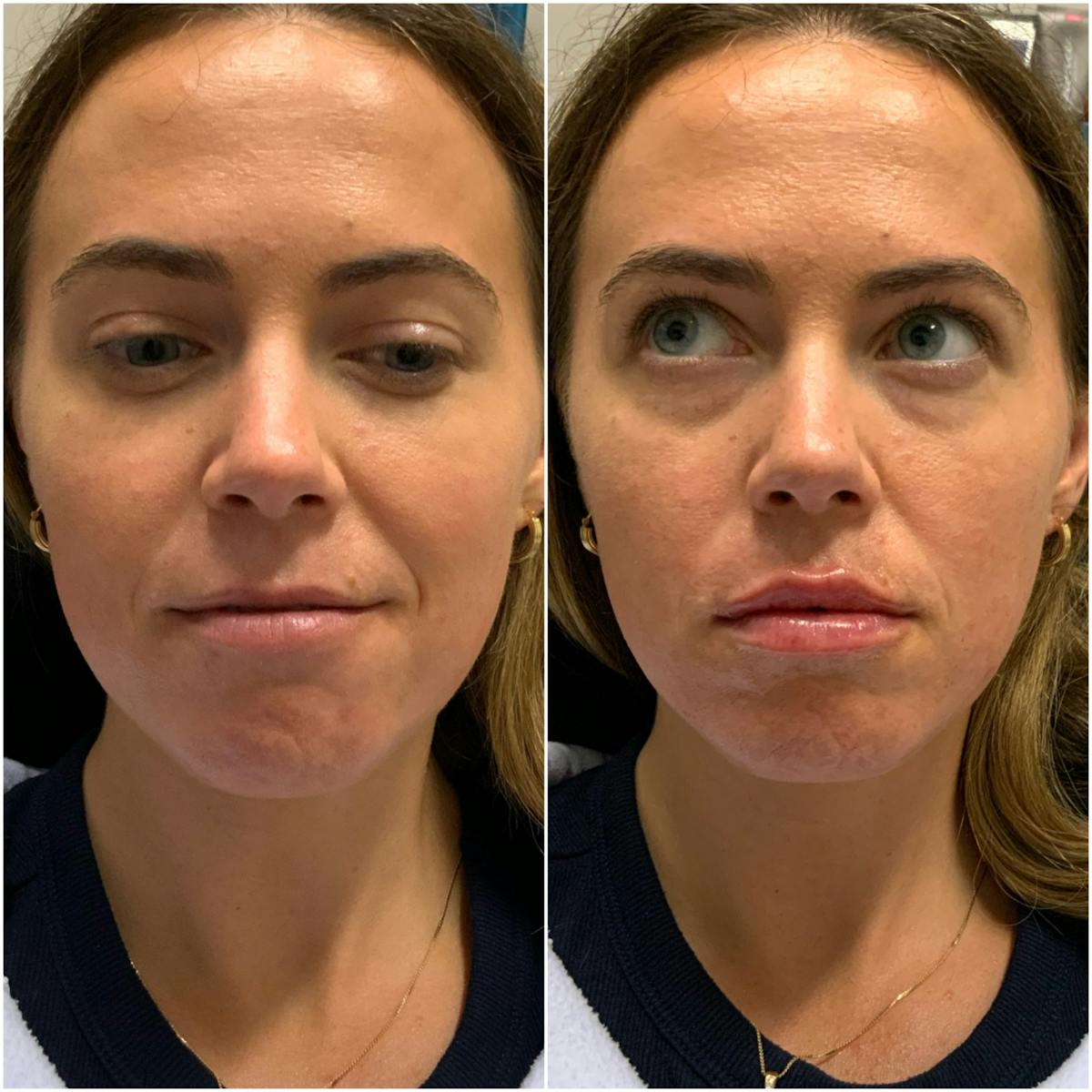 Lip Filler Before & After Gallery - Patient 899889 - Image 1