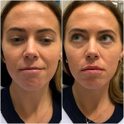 Lip Filler Before & After Gallery - Patient 899889 - Image 1