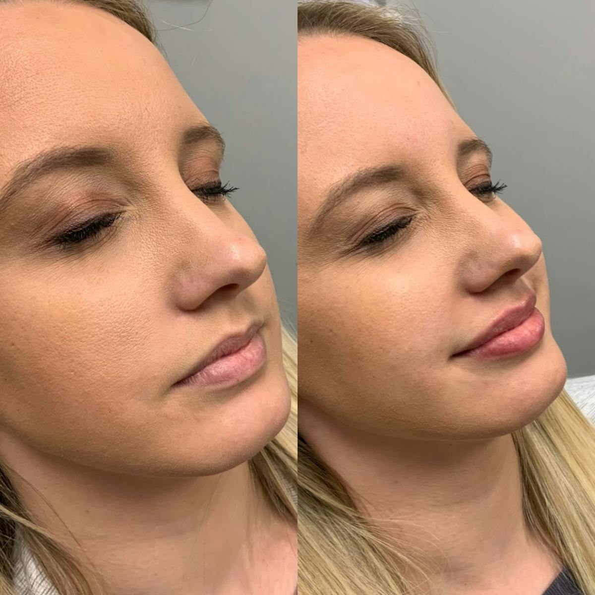 Lip Filler Before & After Gallery - Patient 166864 - Image 2