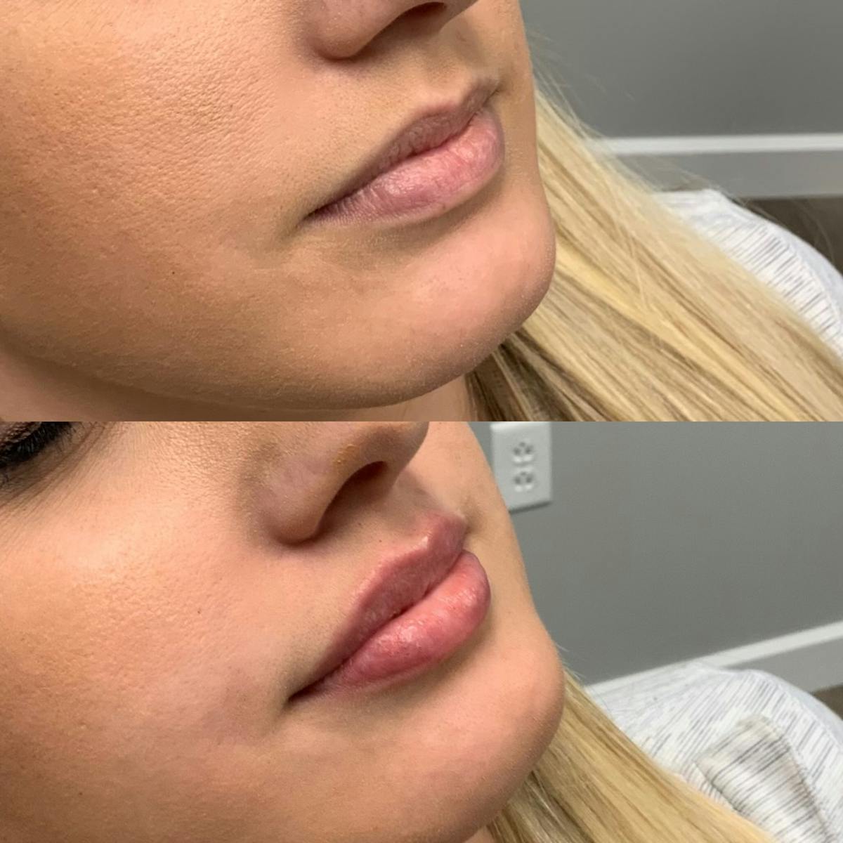 Lip Filler Before & After Gallery - Patient 166864 - Image 3