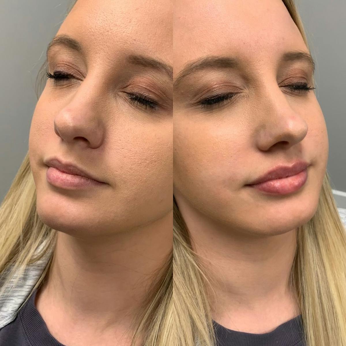 Lip Filler Before & After Gallery - Patient 166864 - Image 1