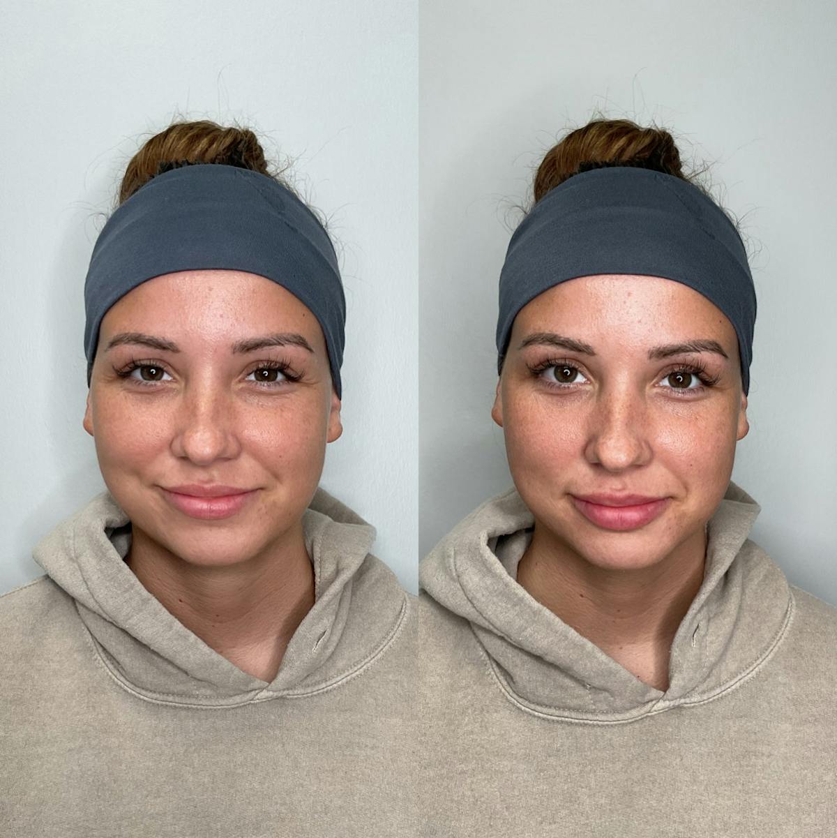 Lip Filler Before & After Gallery - Patient 106349 - Image 1