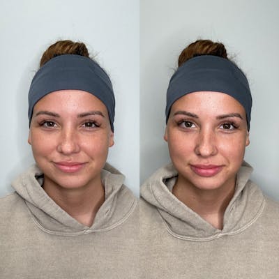 Lip Filler Before & After Gallery - Patient 106349 - Image 1