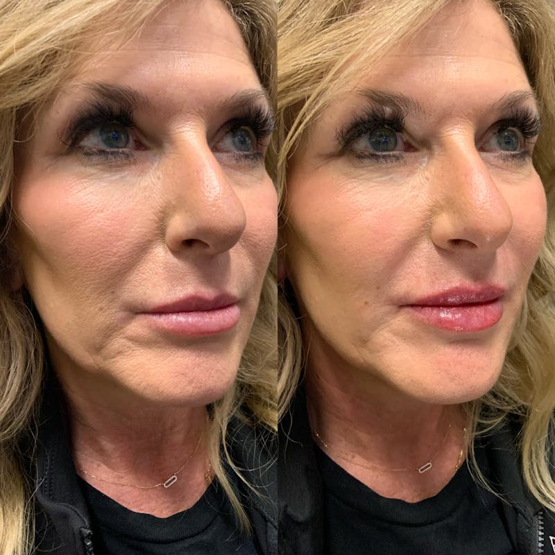 Lip Filler Before & After Gallery - Patient 315900 - Image 1