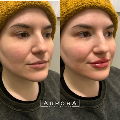 Lip Filler Before & After Gallery - Patient 374500 - Image 1