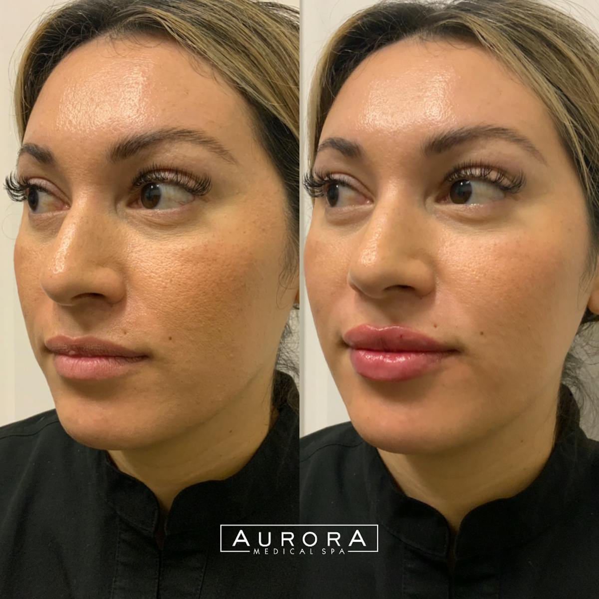 Lip Filler Before & After Gallery - Patient 828886 - Image 1