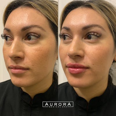 Lip Filler Before & After Gallery - Patient 828886 - Image 1