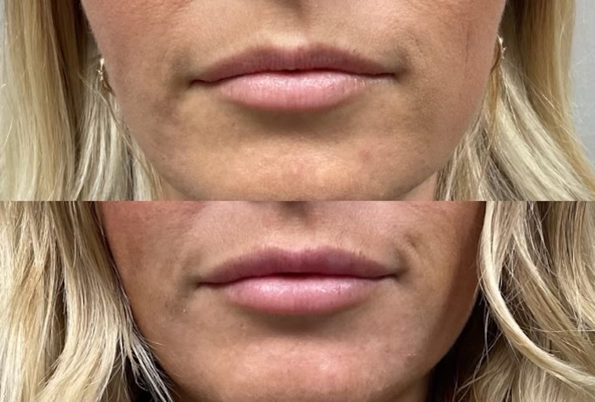 Lip Filler Before & After Gallery - Patient 307159 - Image 2